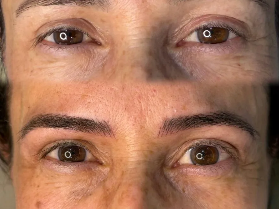 Antes e depois de micropigmentação de sobrancelha com remoção e correção a laser, resultado natural, em Caraguatatuba