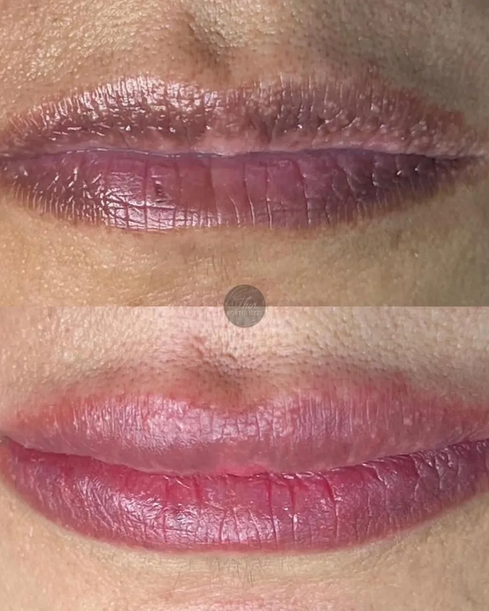 Antes e depois de neutralização labial, de lábios escurecidos para tom rosado natural