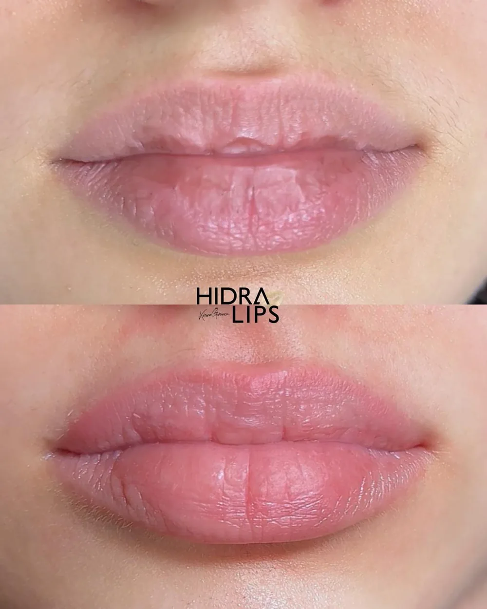 Antes e depois de Hidra Lips, lábios hidratados com efeito gloss e cor natural