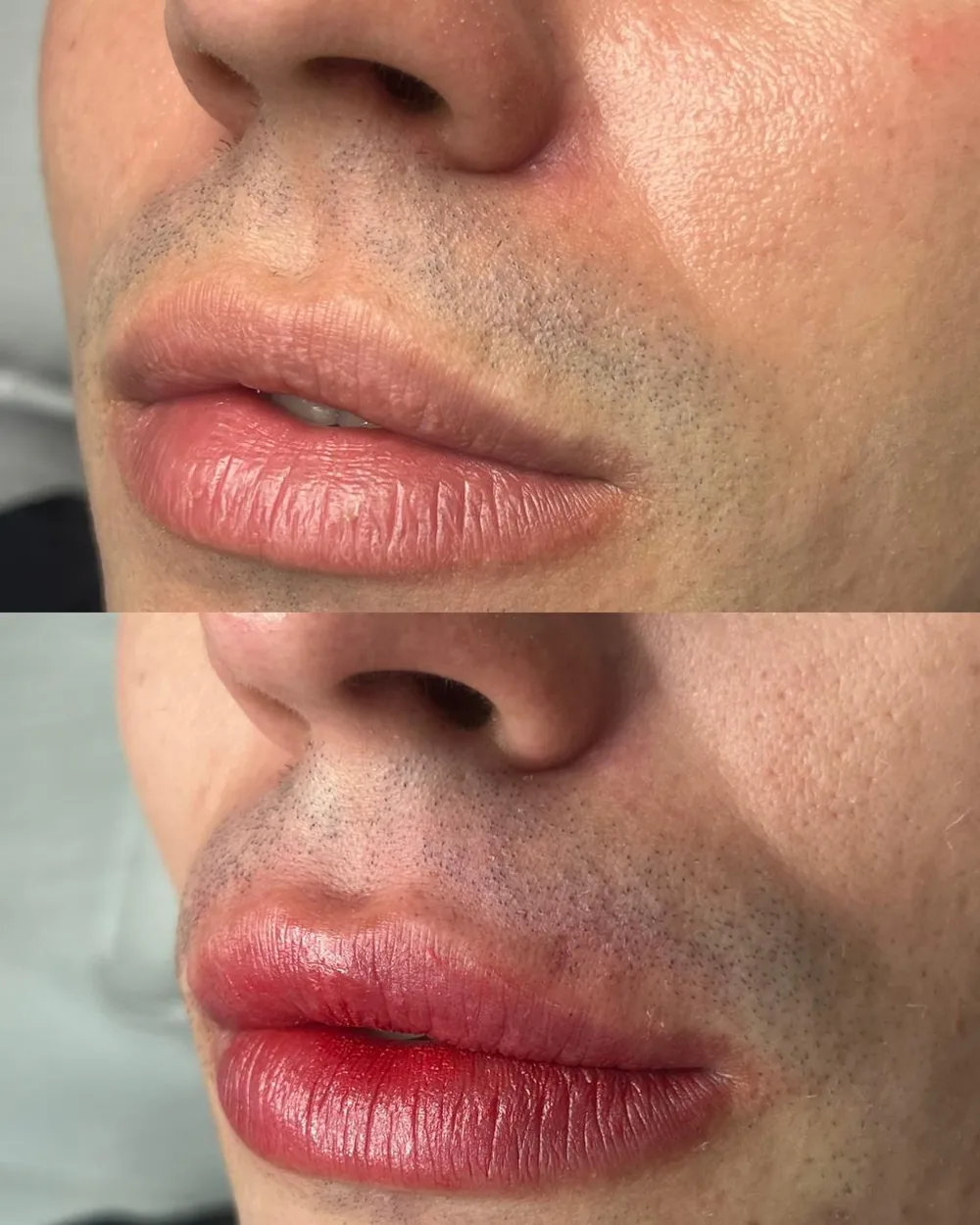 Antes e depois de micropigmentação labial masculina, cor e contorno naturais