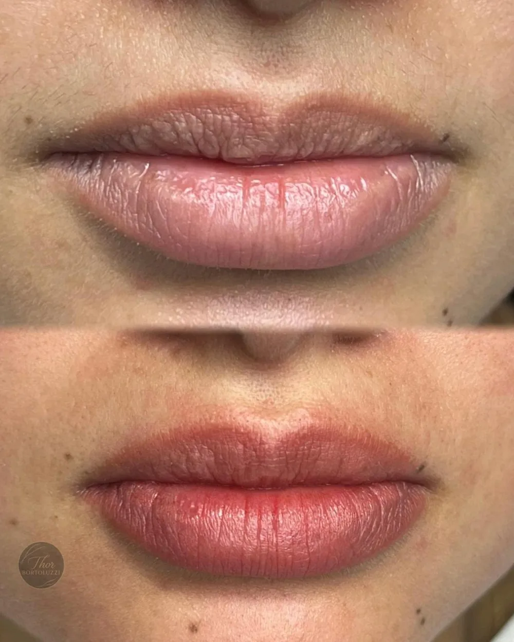 Antes e depois de revitalização labial feminina, cor renovada com resultado natural